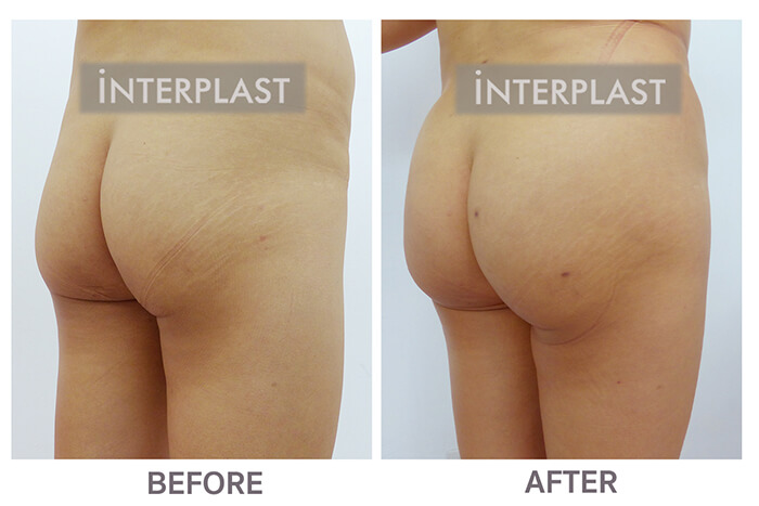 buttock augmentation in bangkok 01