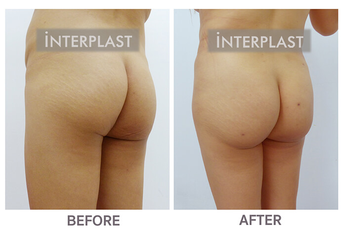buttock augmentation in bangkok 02