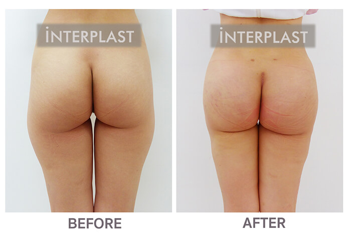 buttock augmentation in bangkok 05